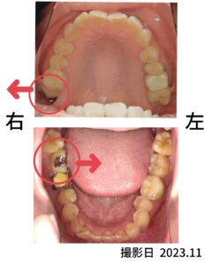 臼歯念転 治療前の写真