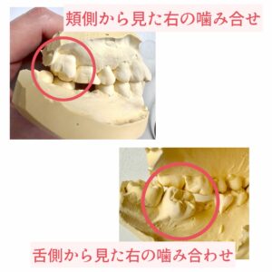 念転している歯