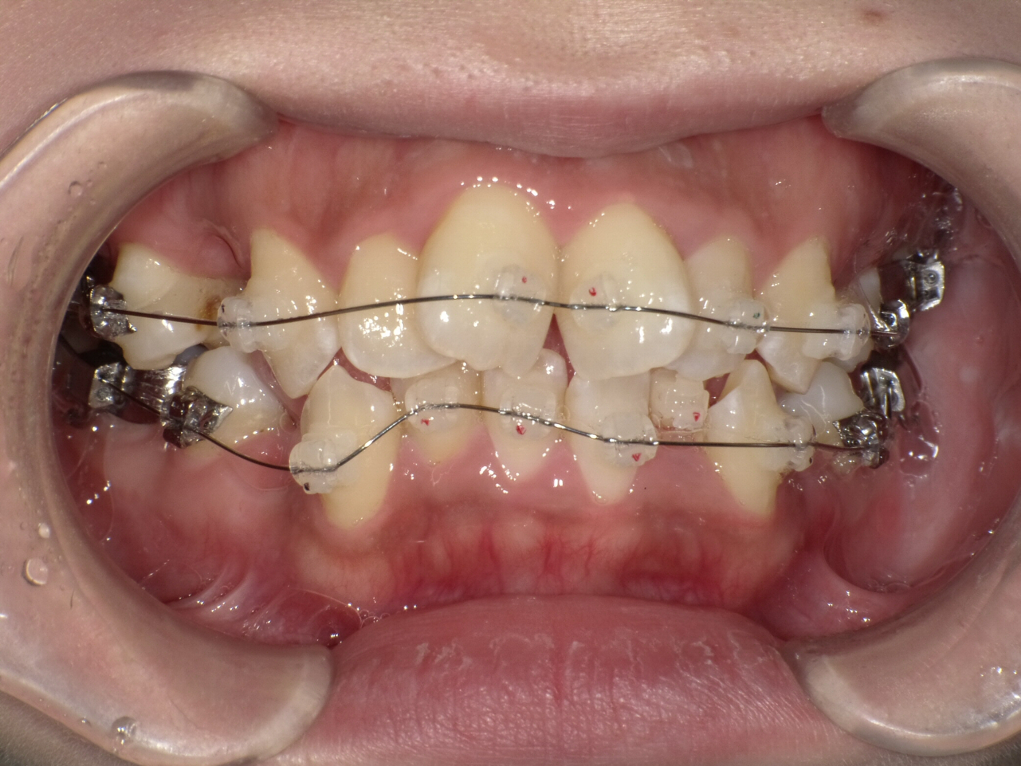 スタッフ歯科矯正～装置～のイメージ