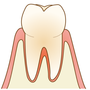 歯周病　残存歯