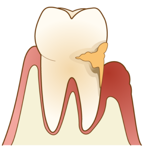 歯周病　残存歯