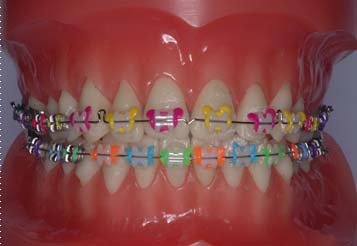 歯科矯正の精密検査のイメージ