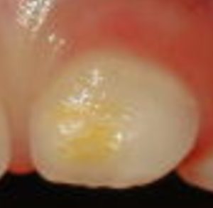 あれ 歯の色がおかしい エナメル質形成不全 滋賀県草津市 歯医者 歯科 アキヨシデンタルクリニック 小児歯科 矯正歯科 審美歯科 インプラント治療