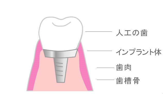 インプラント