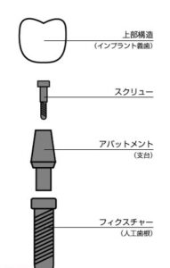 インプラントスクリュー固定